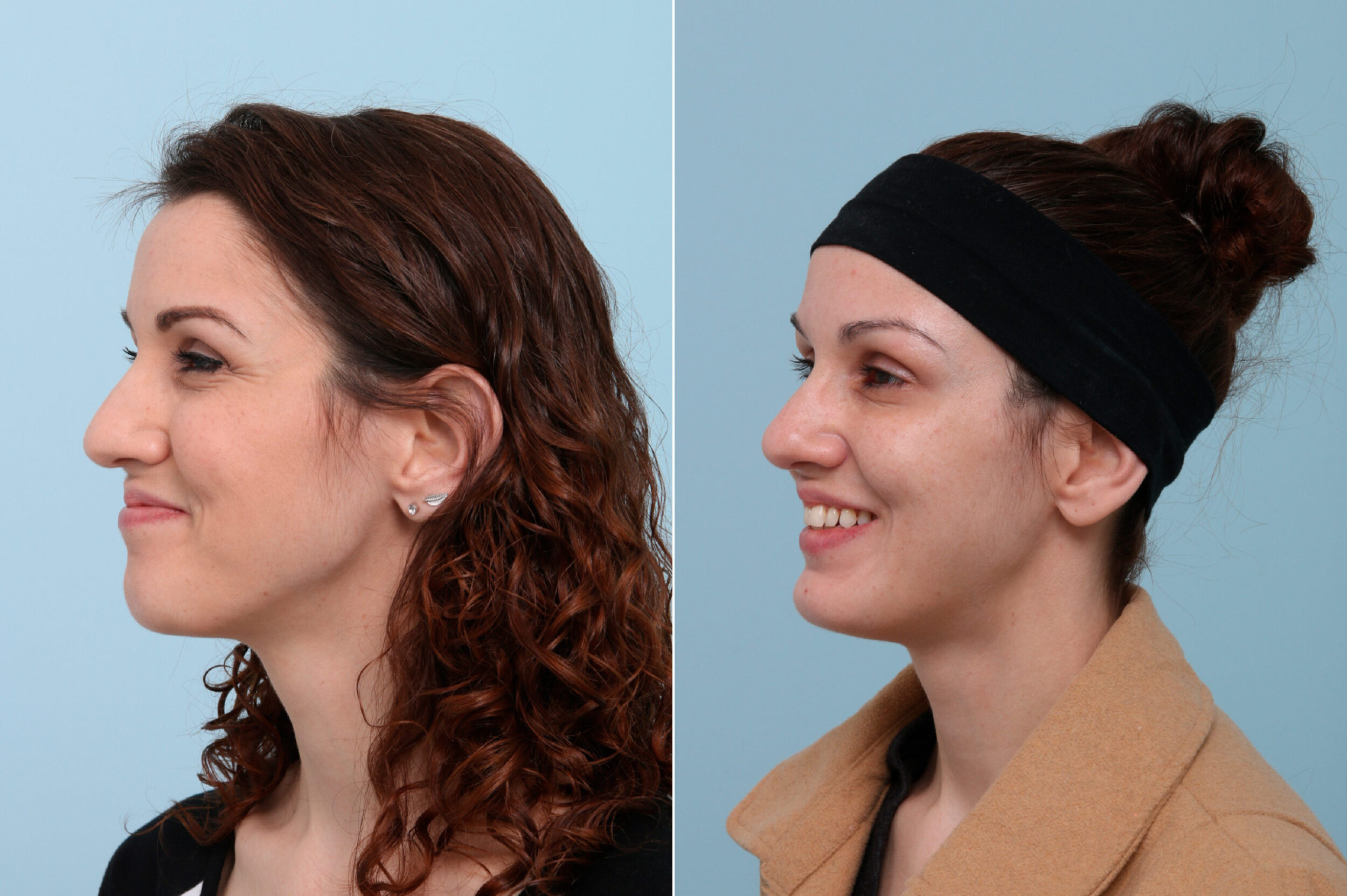 Before and After Image: Botox® Cosmetic & Xeomin Before and After Photos in Houston, TX, Patient 7745 - left-front-oblique
