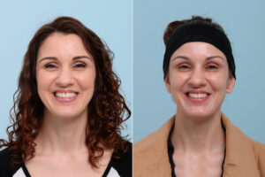 patient 7745 botox cosmetic before after scaled