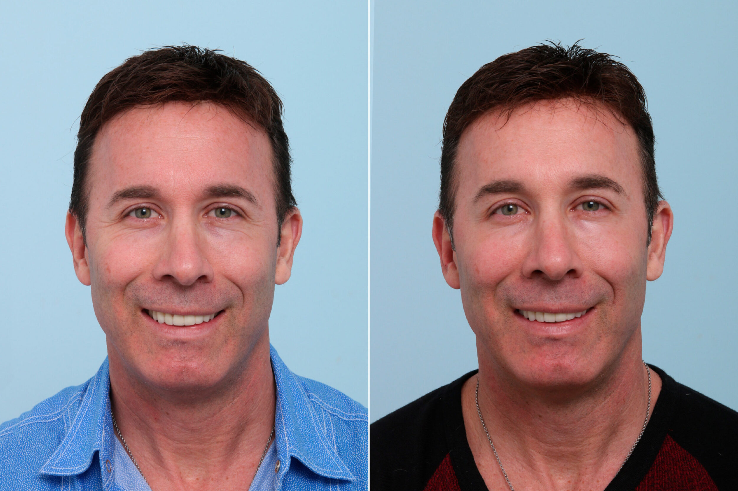 Before and After Image: Botox® Cosmetic & Xeomin Before and After Photos in Houston, TX, Patient 7757 - front