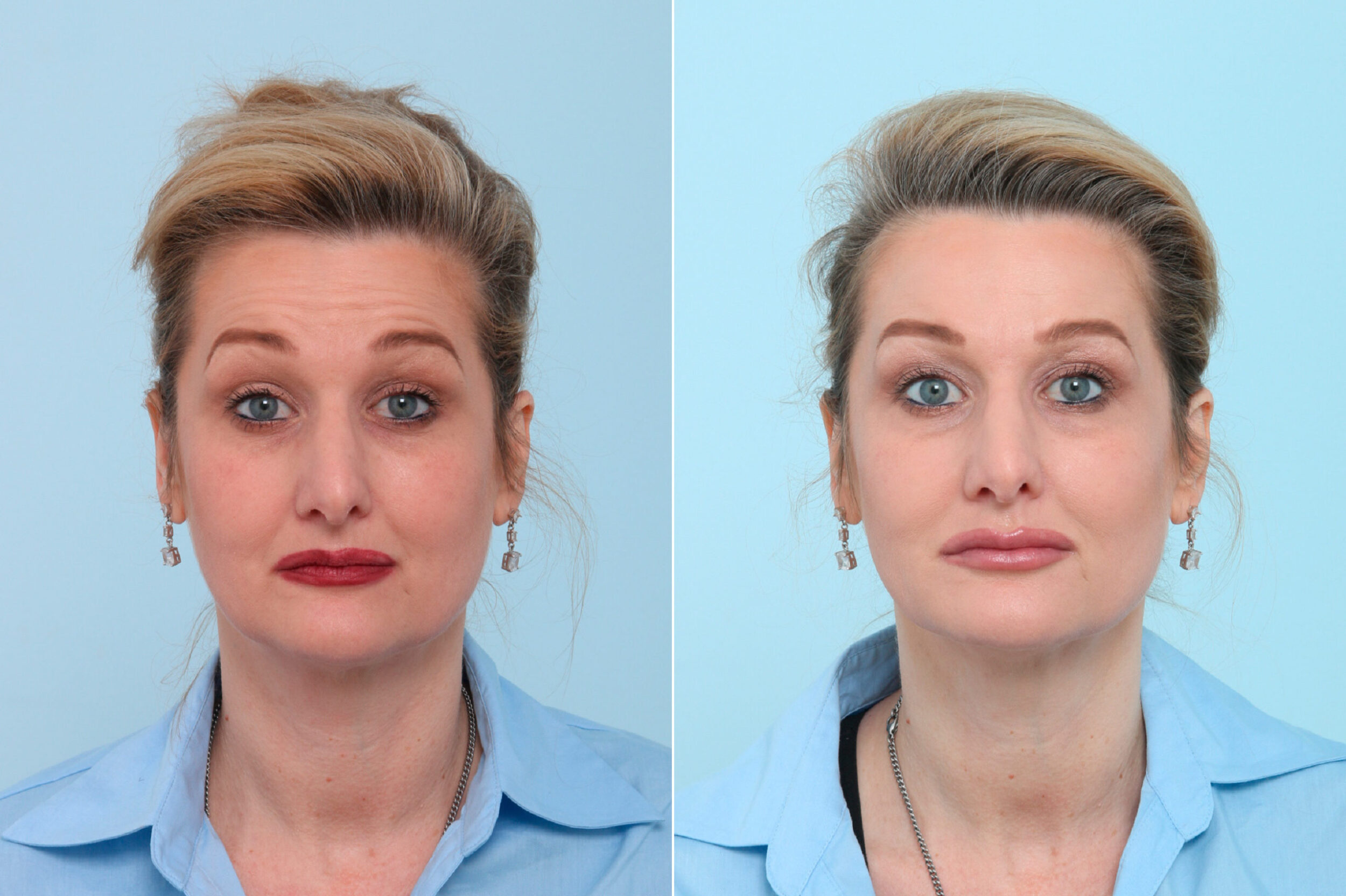 Before and After Image: Botox® Cosmetic & Xeomin Before and After Photos in Houston, TX, Patient 7770 - front