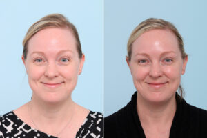 patient 7775 botox cosmetic before after scaled