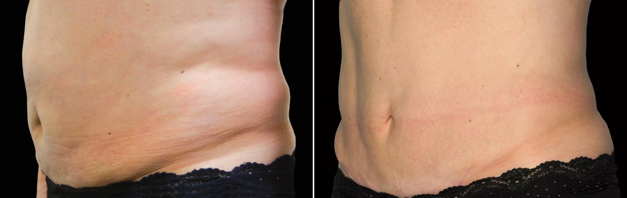 Before and After Image: CoolSculpting Before and After Photos in Houston, TX, Patient 7780 - left-front-oblique