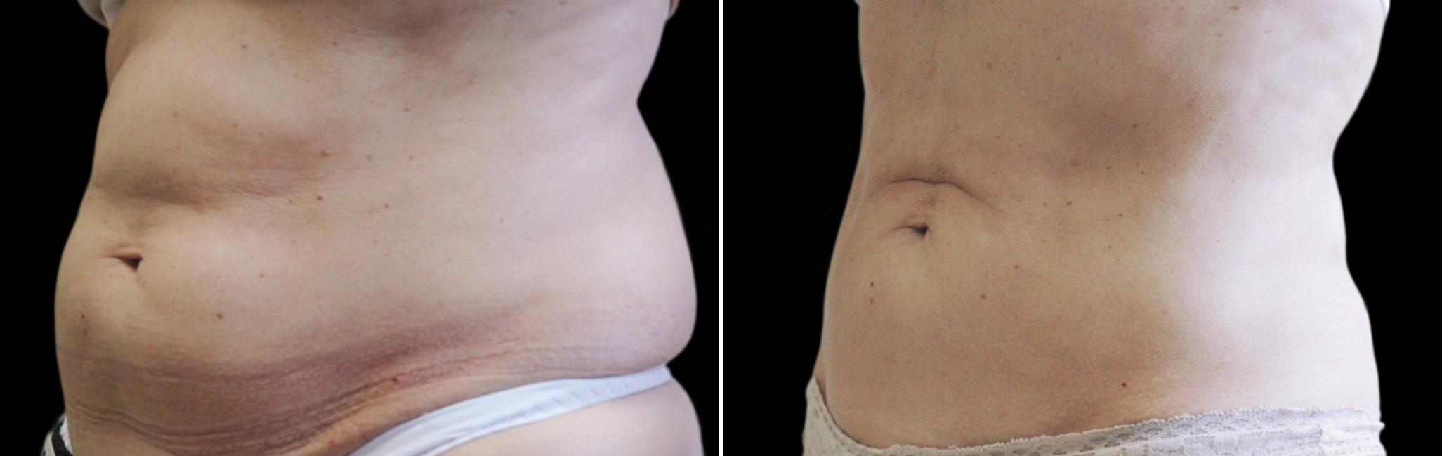Before and After Image: CoolSculpting Before and After Photos in Houston, TX, Patient 7817 - left-front-oblique