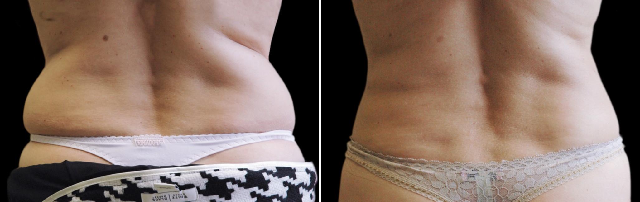 Before and After Image: CoolSculpting Before and After Photos in Houston, TX, Patient 7817 - back