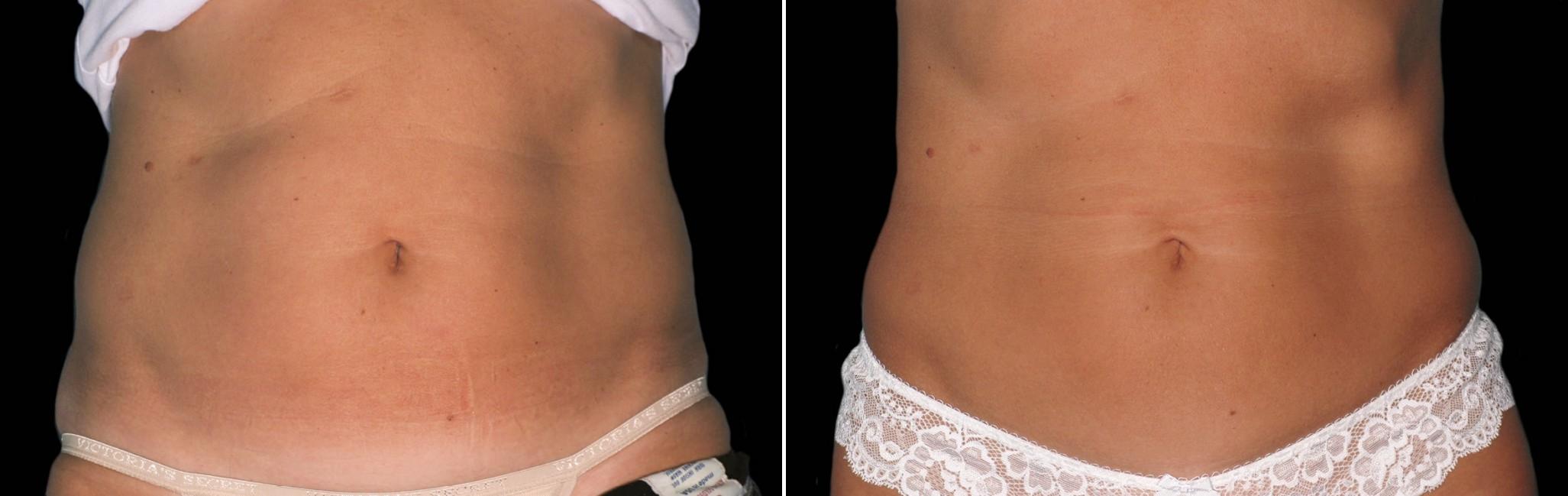 Before and After Image: CoolSculpting Before and After Photos in Houston, TX, Patient 7785 - front