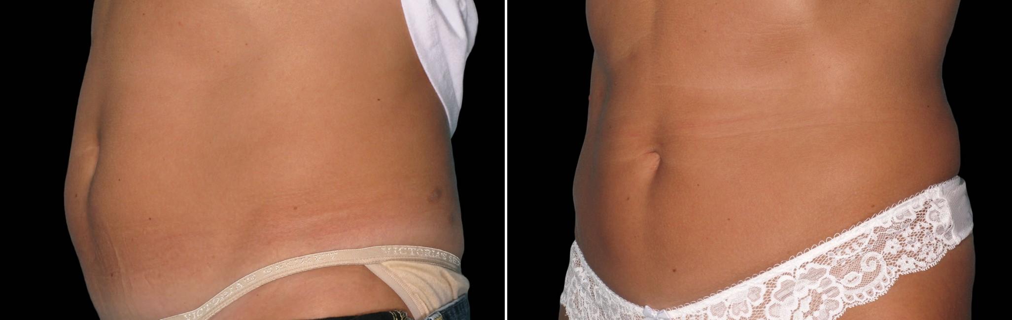 Before and After Image: CoolSculpting Before and After Photos in Houston, TX, Patient 7785 - left-front-oblique