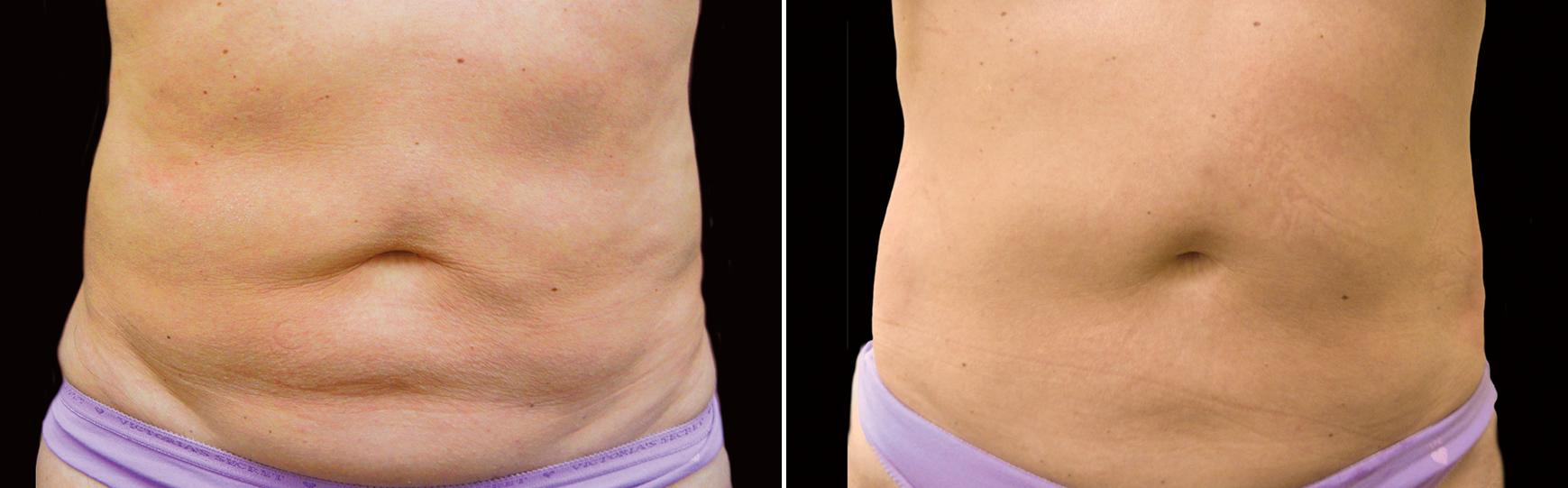 Before and After Image: CoolSculpting Before and After Photos in Houston, TX, Patient 7790 - front