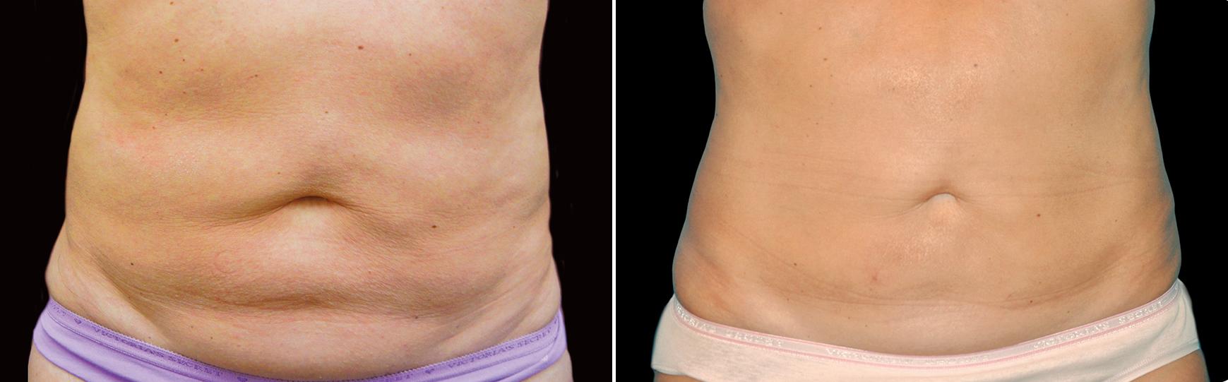 Before and After Image: CoolSculpting Before and After Photos in Houston, TX, Patient 7790 - front