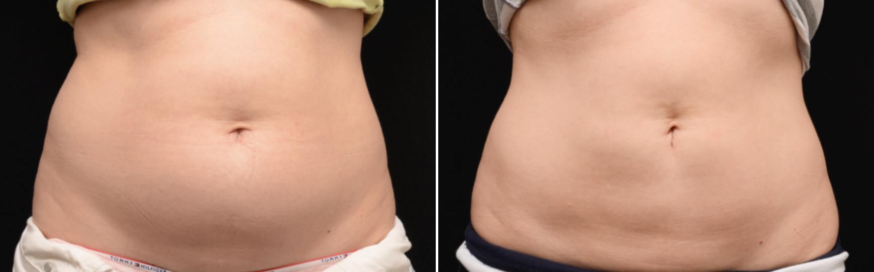 Before and After Image: CoolSculpting Before and After Photos in Houston, TX, Patient 7798 - front