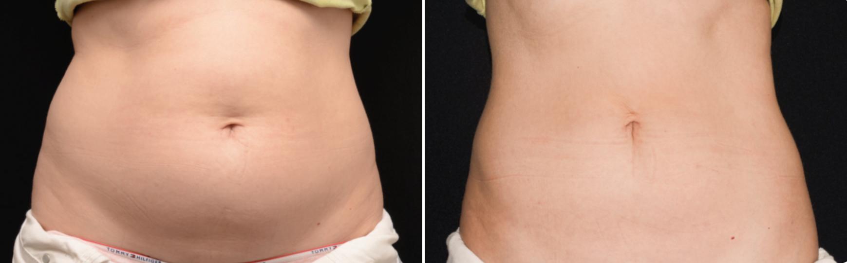 Before and After Image: CoolSculpting Before and After Photos in Houston, TX, Patient 7798 - front
