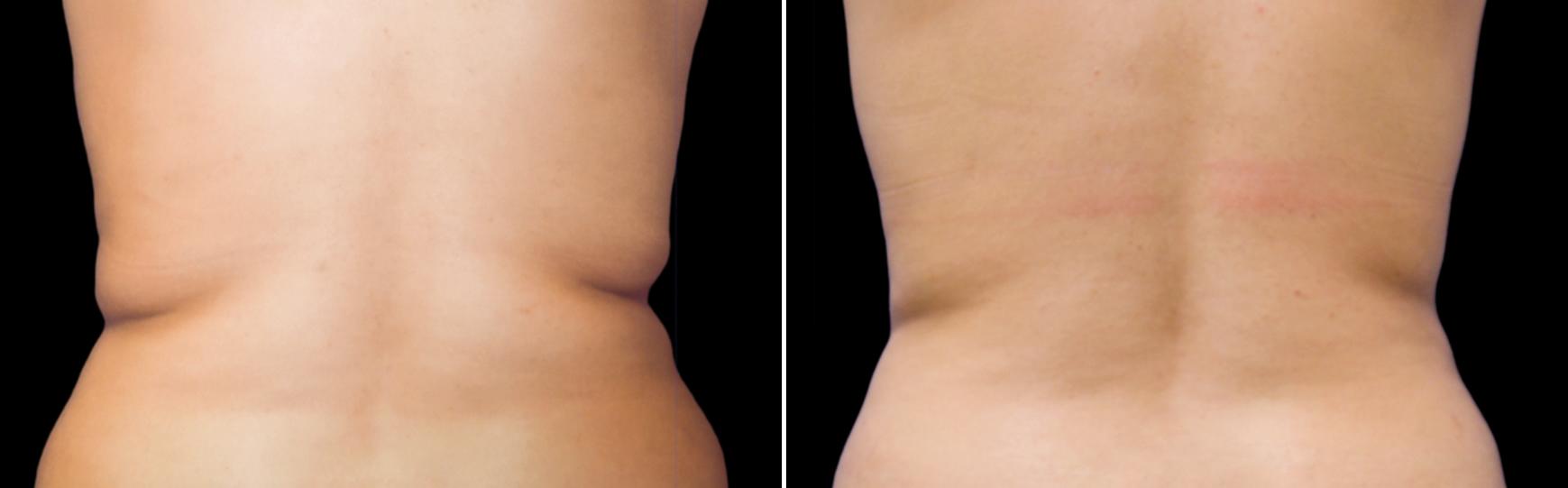 Before and After Image: CoolSculpting Before and After Photos in Houston, TX, Patient 7803 - front