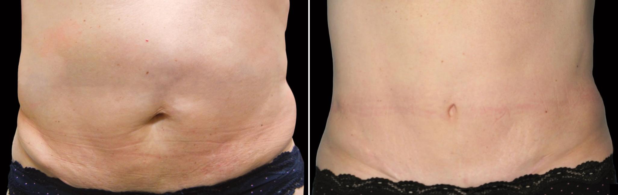 Before and After Image: CoolSculpting Before and After Photos in Houston, TX, Patient 7780 - front