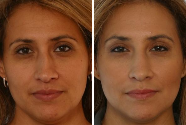 Before and After Image: Fillers Before and After Photos in Houston, TX, Patient 7898 - front