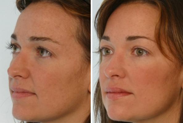 Before and After Image: Fillers Before and After Photos in Houston, TX, Patient 7880 - left-front-oblique