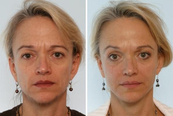 Before and After Image: Fillers Before and After Photos in Houston, TX, Patient 7923 - front