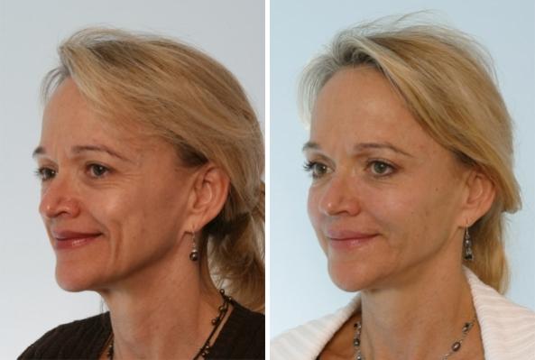 Before and After Image: Fillers Before and After Photos in Houston, TX, Patient 7923 - left-front-oblique