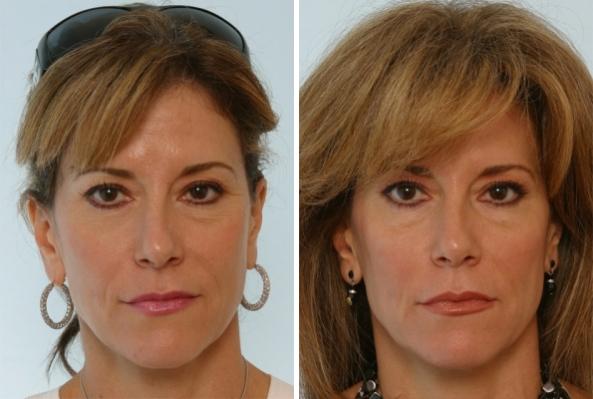 Before and After Image: Fillers Before and After Photos in Houston, TX, Patient 7928 - front