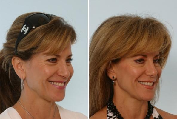 Before and After Image: Fillers Before and After Photos in Houston, TX, Patient 7928 - right-front-oblique