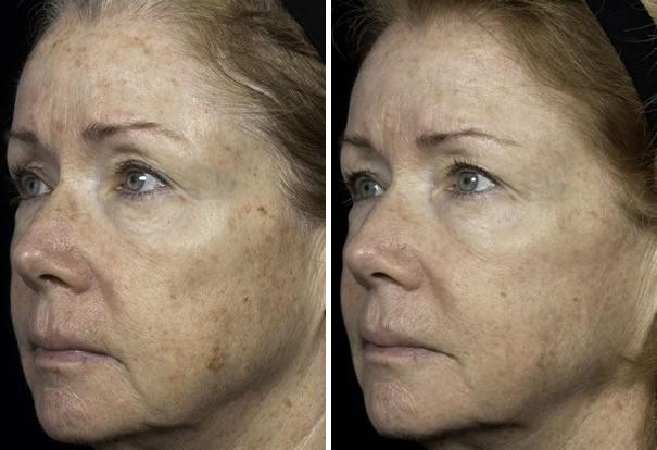 Before and After Image: Fraxel Laser Before and After Photos in Houston, TX, Patient 7941 - left-front-oblique