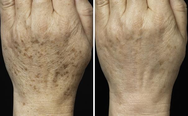 Before and After Image: Fraxel Laser Before and After Photos in Houston, TX, Patient 7947 - back