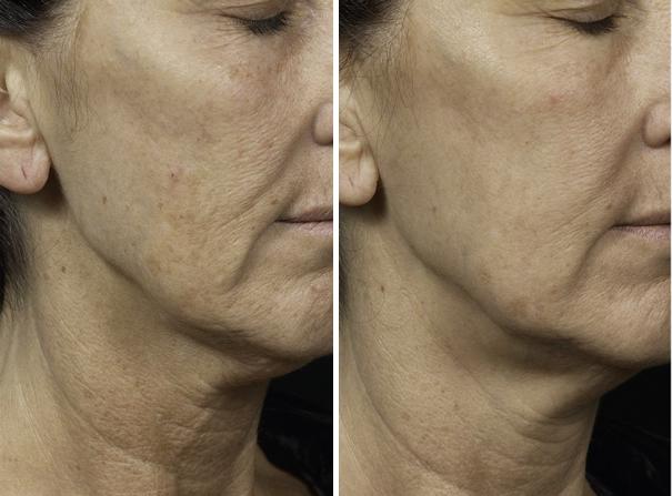 Before and After Image: Fraxel Laser Before and After Photos in Houston, TX, Patient 7950 - right-front-oblique