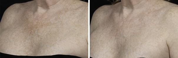 Before and After Image: Fraxel Laser Before and After Photos in Houston, TX, Patient 7956 - left-front-oblique