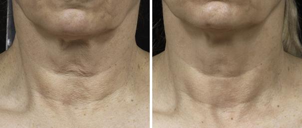 Before and After Image: Fraxel Laser Before and After Photos in Houston, TX, Patient 7959 - front