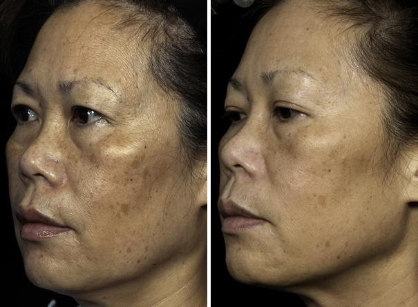 Before and After Image: Fraxel Laser Before and After Photos in Houston, TX, Patient 7965 - left-front-oblique