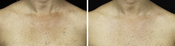 Before and After Image: Fraxel Laser Before and After Photos in Houston, TX, Patient 7938 - front