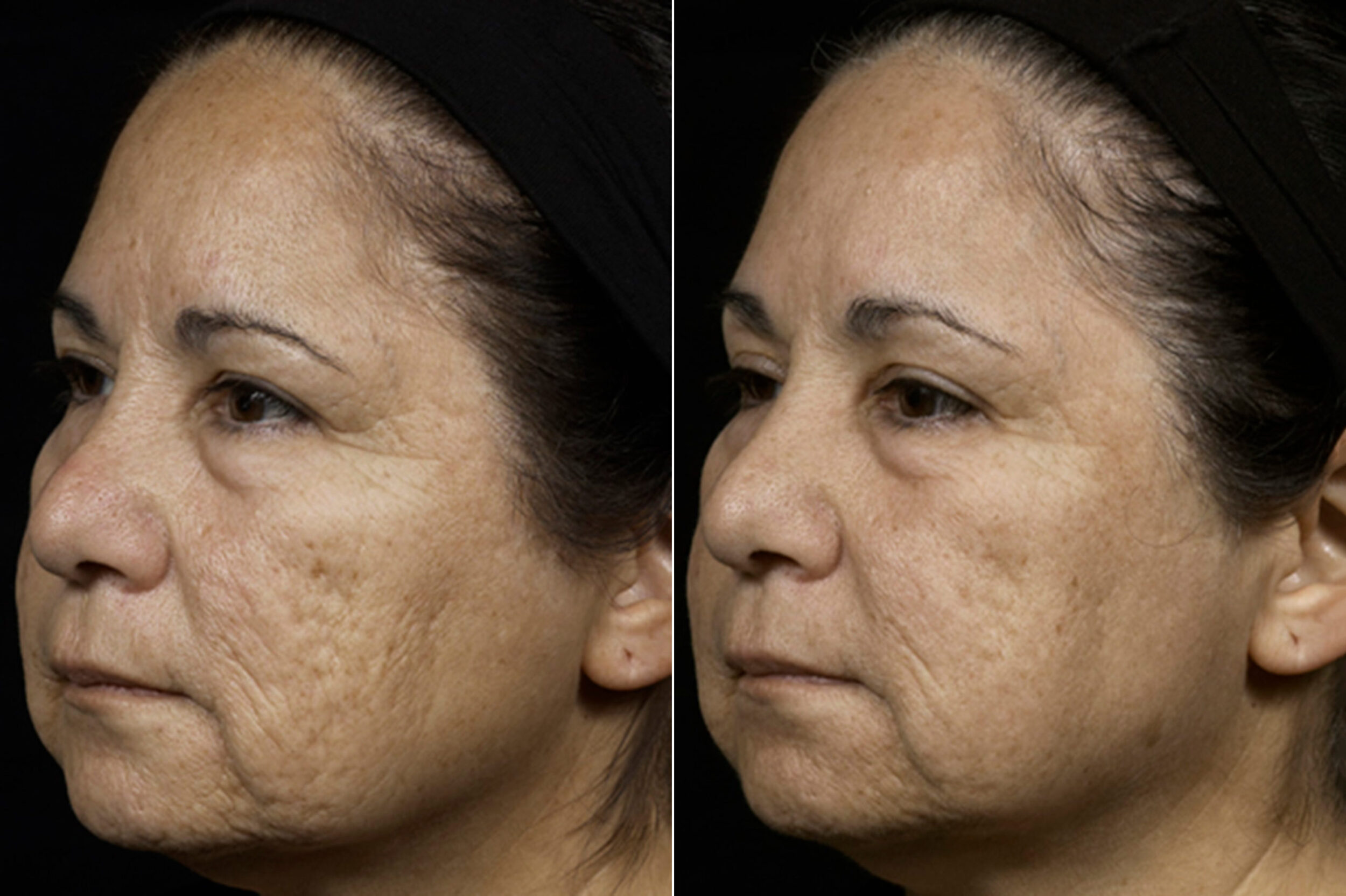 Before and After Image: Fraxel Laser Before and After Photos in Houston, TX, Patient 7962 - left-front-oblique