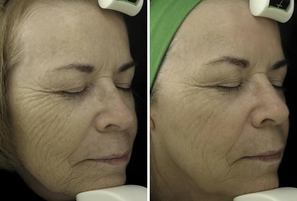 Before and After Image: Fraxel Laser Before and After Photos in Houston, TX, Patient 7968 - right-front-oblique