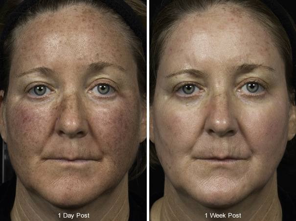 Before and After Image: Fraxel Laser Before and After Photos in Houston, TX, Patient 7971 - front