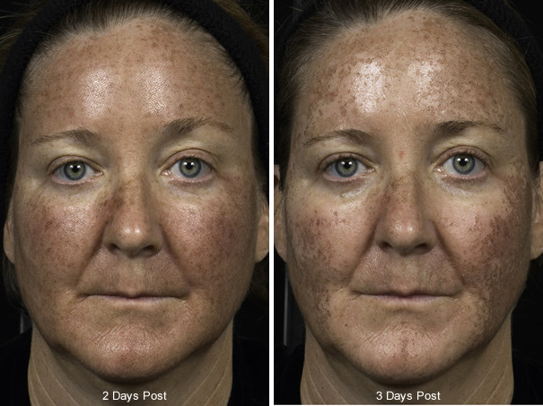 Before and After Image: Fraxel Laser Before and After Photos in Houston, TX, Patient 7971 - front