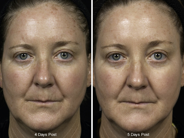 Before and After Image: Fraxel Laser Before and After Photos in Houston, TX, Patient 7971 - front