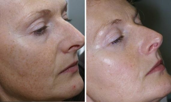 patient 7980 ipl before after 1 570x340
