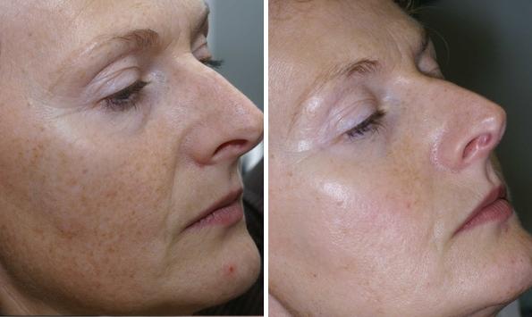 Before and After Image: IPL Before and After Photos in Houston, TX, Patient 7983 - right-front-oblique