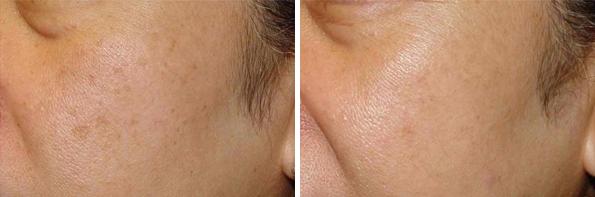 Before and After Image: IPL Before and After Photos in Houston, TX, Patient 7986 - left-front-oblique