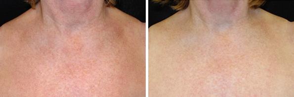 Before and After Image: IPL Before and After Photos in Houston, TX, Patient 7989 - front