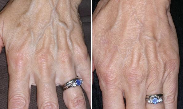 Before and After Image: IPL Before and After Photos in Houston, TX, Patient 7992 - front