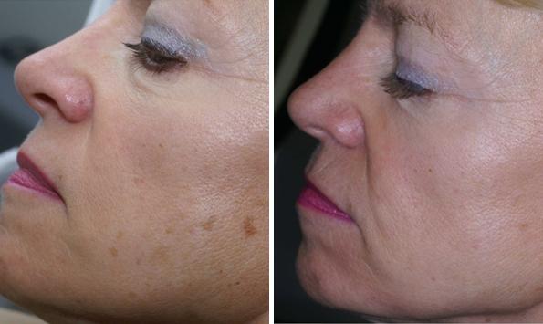 Before and After Image: IPL Before and After Photos in Houston, TX, Patient 7980 - left-front-oblique
