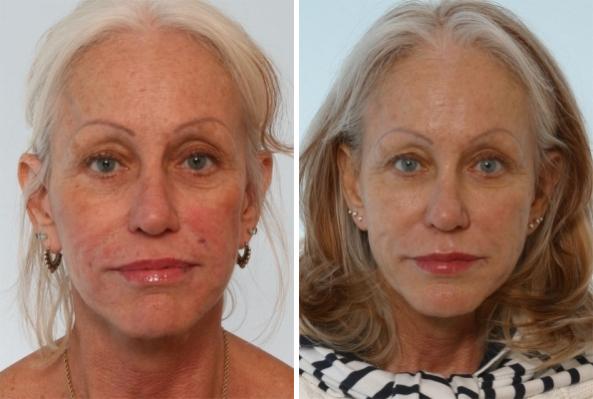 Before and After Image: Fillers Before and After Photos in Houston, TX, Patient 8011 - front