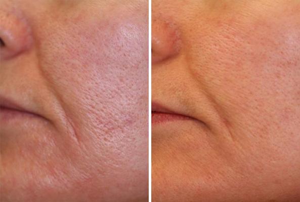 Before and After Image: Laser Genesis Before and After Photos in Houston, TX, Patient 8019 - left-side