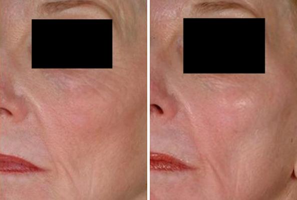Before and After Image: Laser Genesis Before and After Photos in Houston, TX, Patient 8022 - left-front-oblique