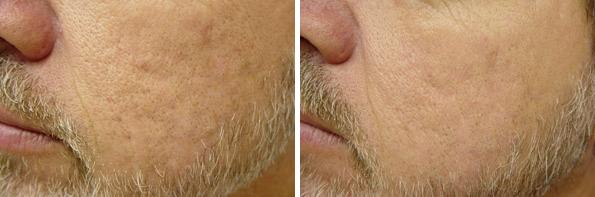 Before and After Image: Laser Genesis Before and After Photos in Houston, TX, Patient 8025 - left-side
