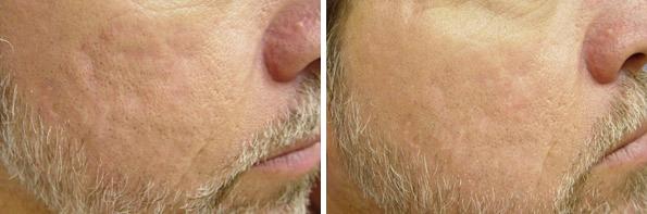 Before and After Image: Laser Genesis Before and After Photos in Houston, TX, Patient 8025 - right-side