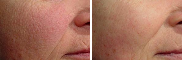 Before and After Image: Laser Genesis Before and After Photos in Houston, TX, Patient 8030 - right-side