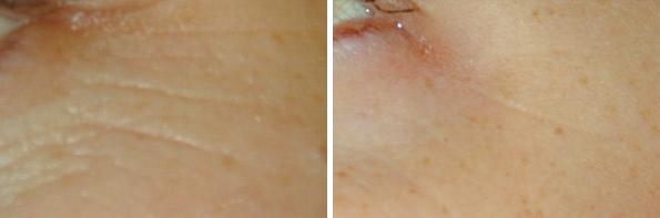 Before and After Image: Laser Genesis Before and After Photos in Houston, TX, Patient 8033 - left-side