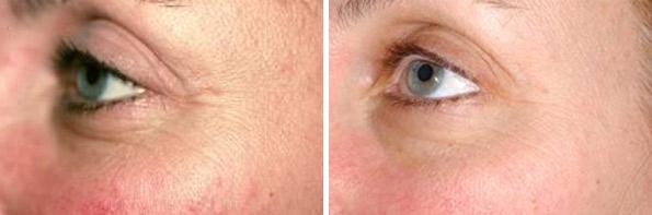 Before and After Image: Laser Genesis Before and After Photos in Houston, TX, Patient 8016 - left-side