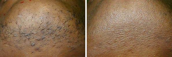 Before and After Image: Laser Hair Removal Before and After Photos in Houston, TX, Patient 8039 - front