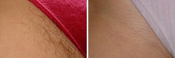 Before and After Image: Laser Hair Removal Before and After Photos in Houston, TX, Patient 8048 - front